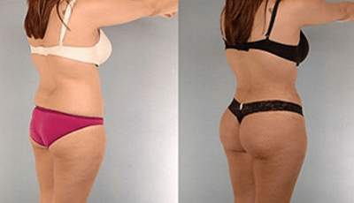 Augmentation des fesses par prothèses naturelles et douce au toucher. Taille et volume modifié et résultat satisfaisant et durable.