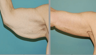 Excès de peau et de graisse sur la face interne des bras après une importante perte de poids. Correction par un lifting du bras après liposuccion. La cicatrice est quasiment invisible.