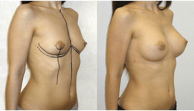 Augmentation du volume des seins par lifting mammaire. Lifting par implants anatomiques de 350 cc.