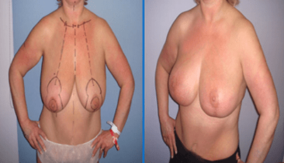 Correction d’une hypertrophie mammaire bilatérale. Intervention réussie de réduction des seins avec une cicatrice en T inversée. 