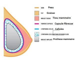 implants mammaires Tunisie