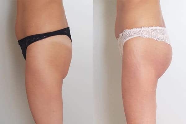 Augmentation fesses Dr Mahmoud
