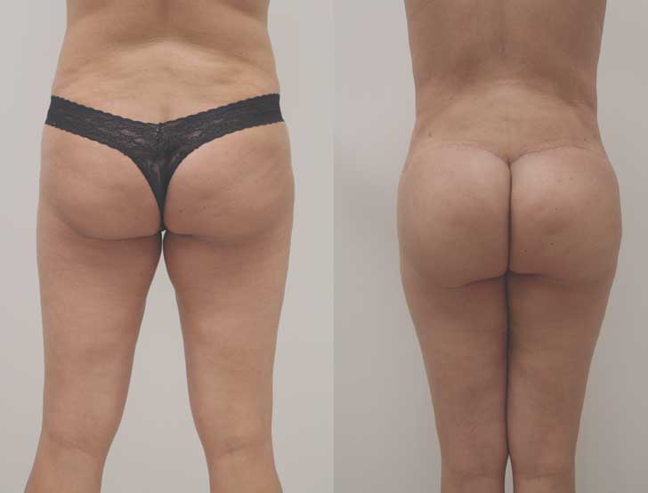 Augmentation fesses sans chirurgie