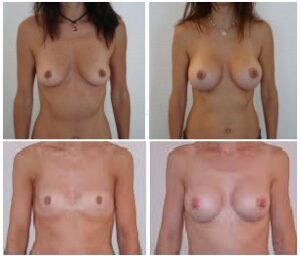 Augmentation du volume des seins par lipofilling : photo avant/après