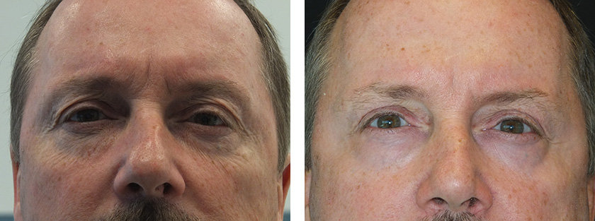 blepharoplastie laser Tunisie