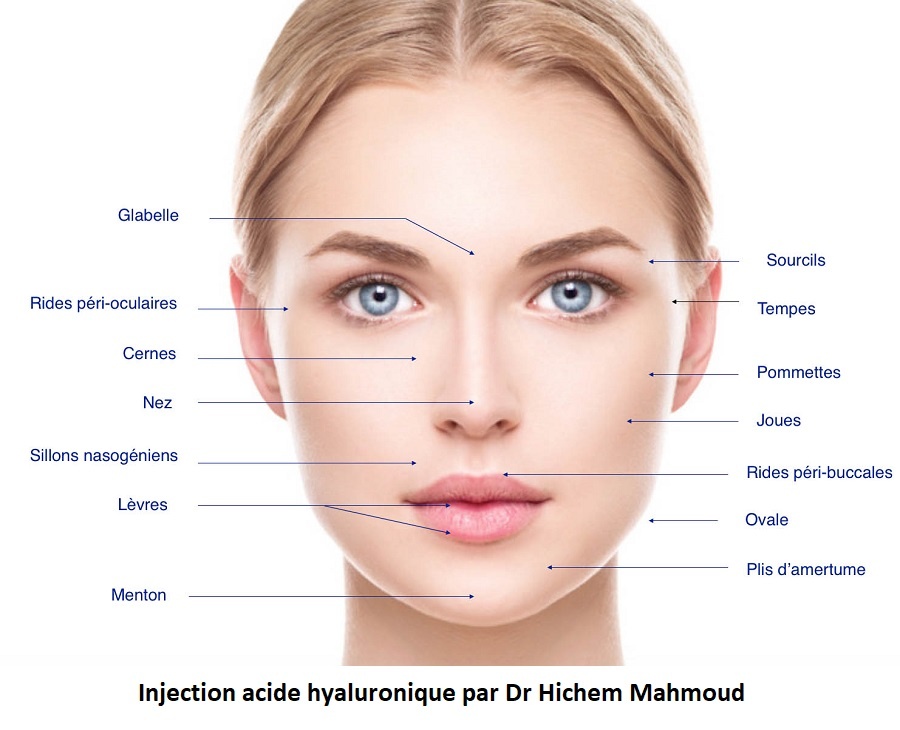 Injection acide hyaluronique