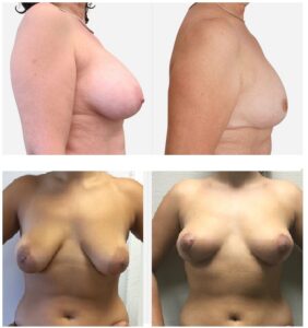 Ptose + hypotrophie mammaire. Traitement chirurgical : augmentation des seins par implants et lifting pour supprimer la peau en excès de la poitrine.